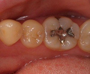 Raritan Dentist - Amalgam Filling