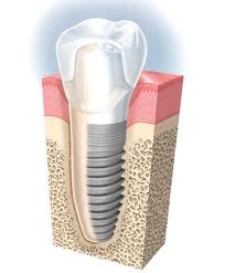 Raritan Dentist - Dental Implant