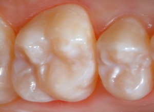 Raritant Dentist - After Sealants